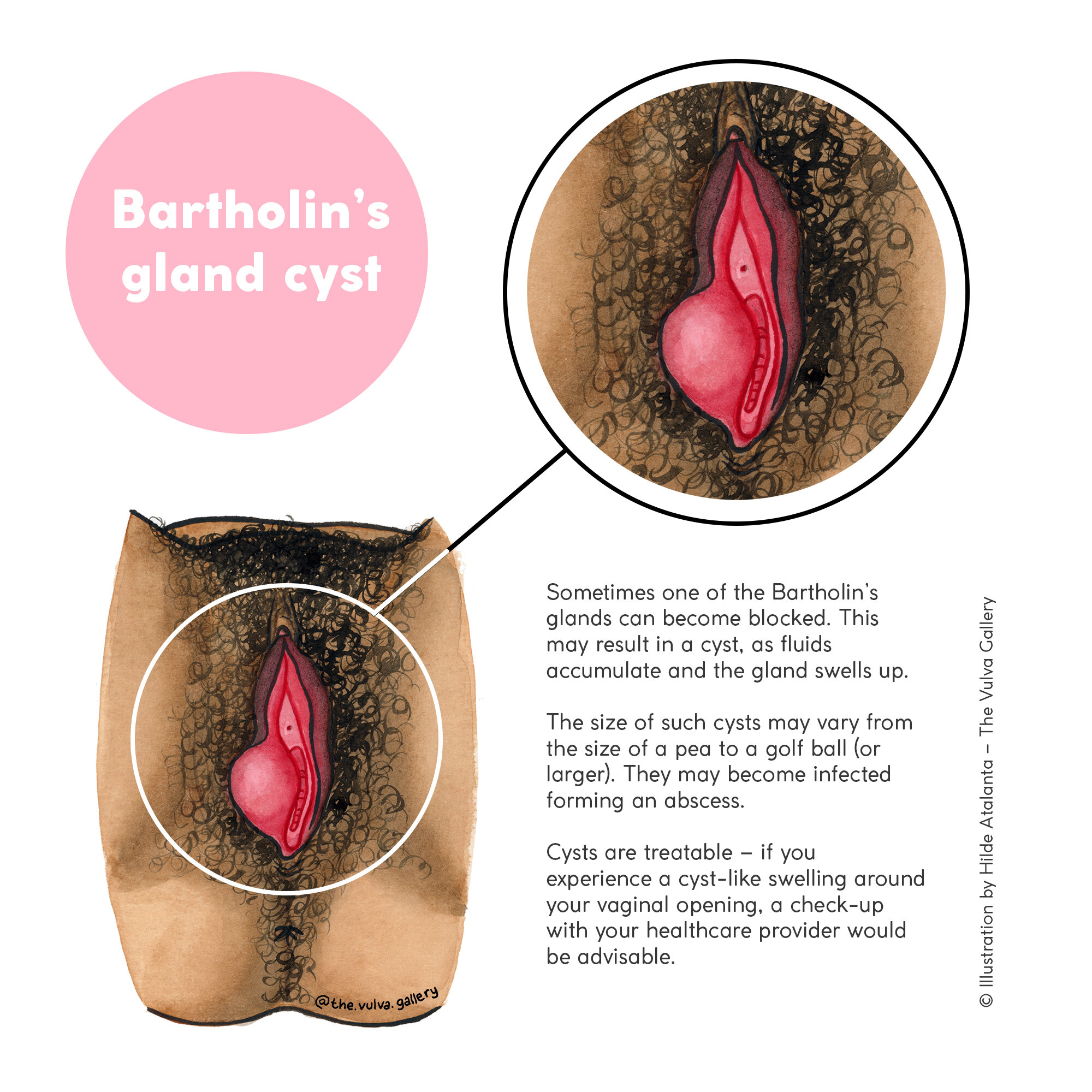Bartholin's Cyst (s).jpg