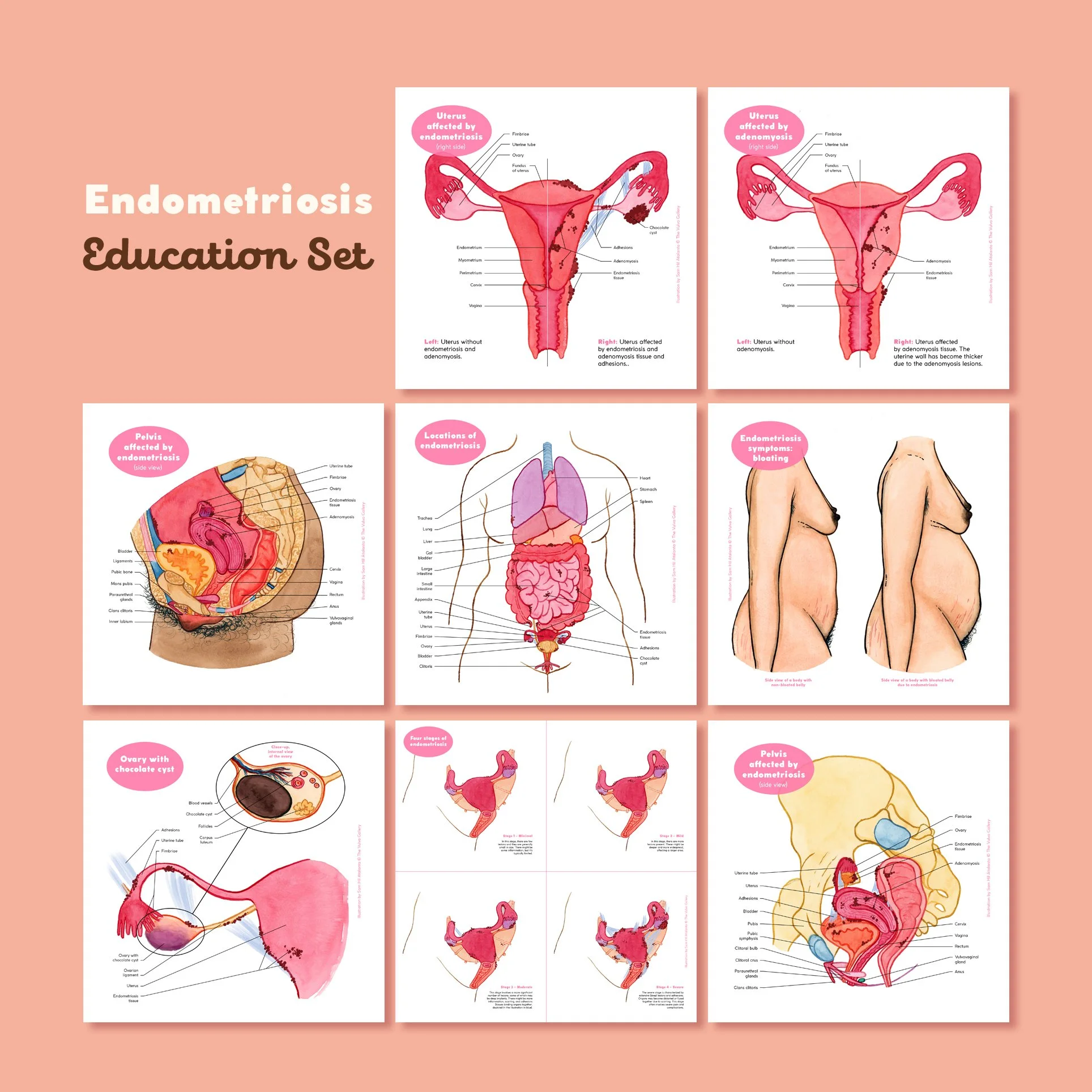 Endometriosis Education Set – All prints – English.jpg