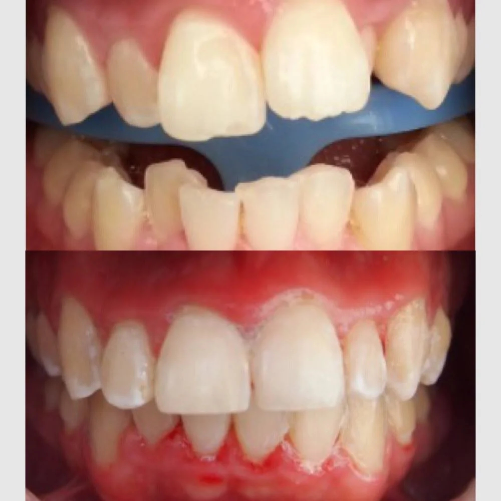 before and after six month smile 2.jpg