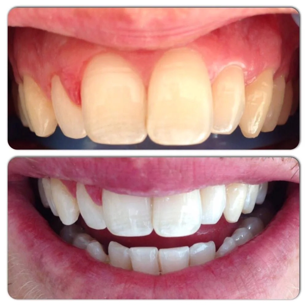 before and after whitening 1 .jpg