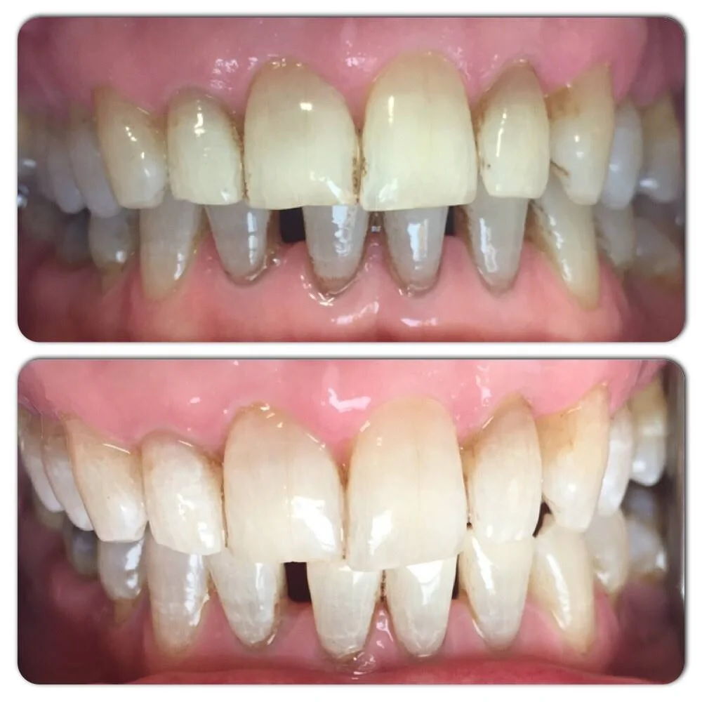 before and after whitening 2 .jpg