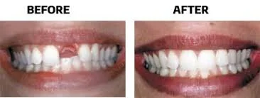 dental implants before and after .jpeg
