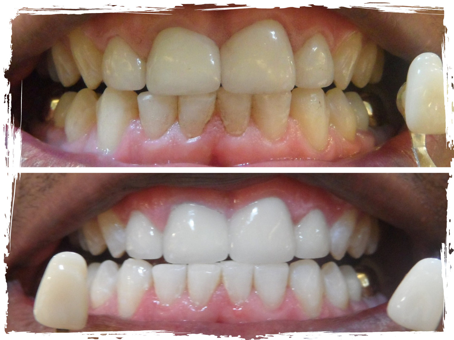 LED Teeth Whitening — Desert Sun Tanning Salons