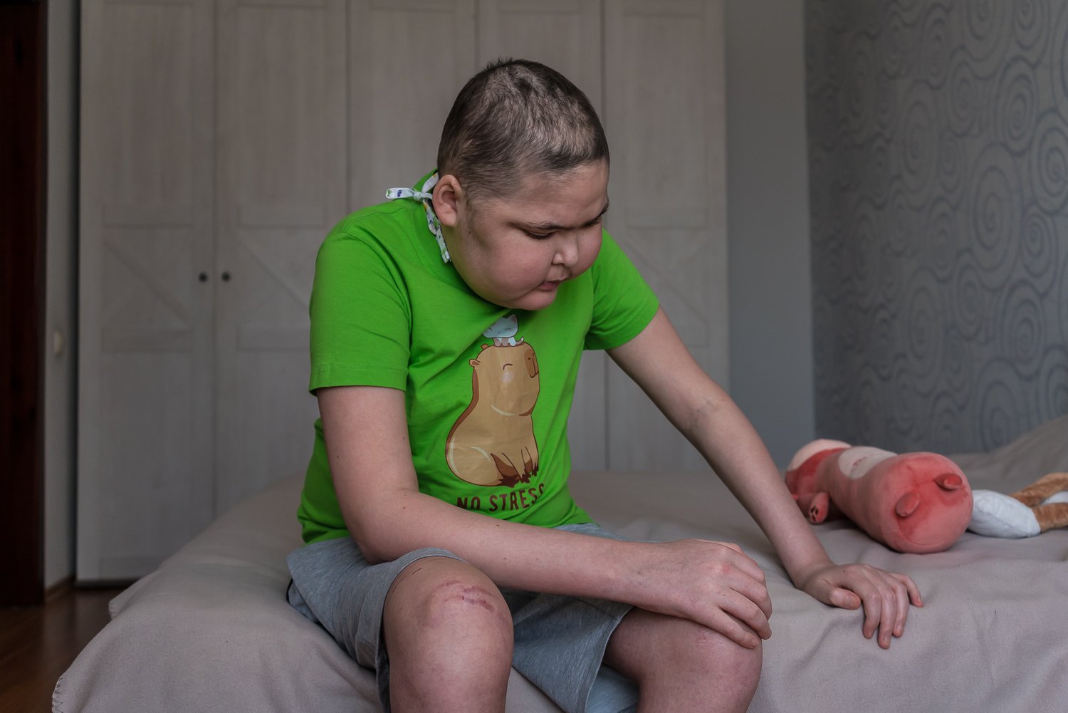  Sasha Batanov, 14, who is being treated at Okhmadyt Children's Hospital for leukemia, on Wednesday, June 21, 2023 in Kyiv, Ukraine. Sasha is from Kharkiv, and his family believes his cancer would have been found sooner if their doctor’s visits had n