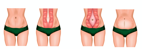 Diastasis Recti