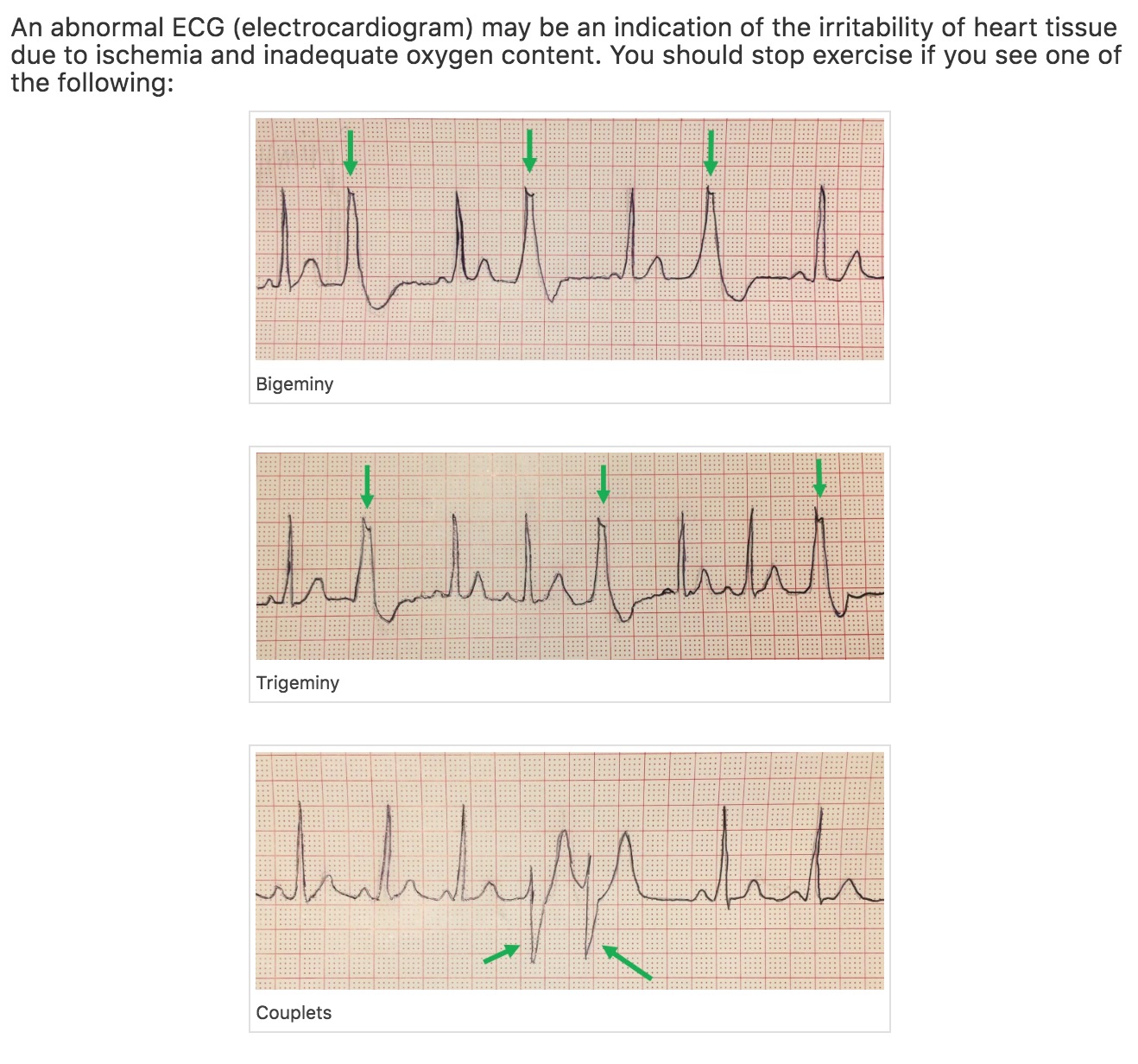 Recognize key ECG patterns for stopping exercise
