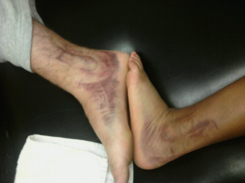 Football player and Cross Country runner with grade III ankle sprains