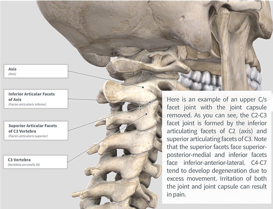 Cervical Facet Syndrome/Spondylosis — PhysioU