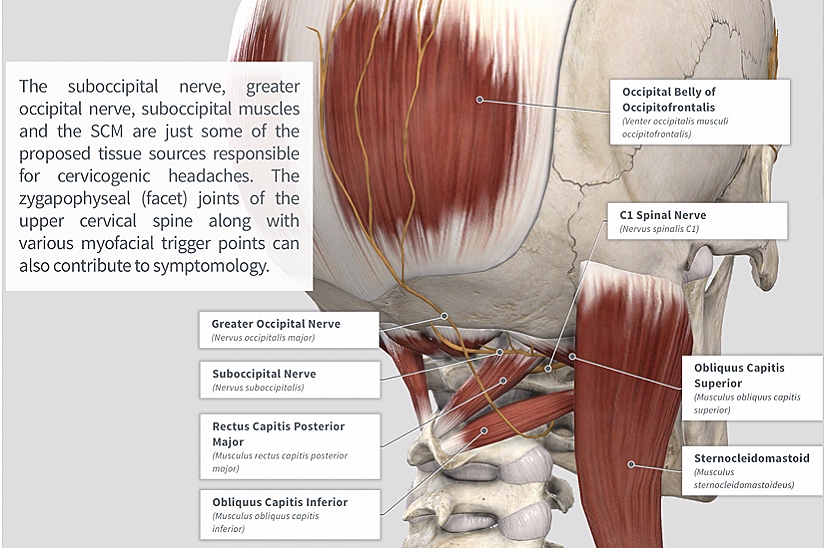 Cervicogenic Headache — PhysioU