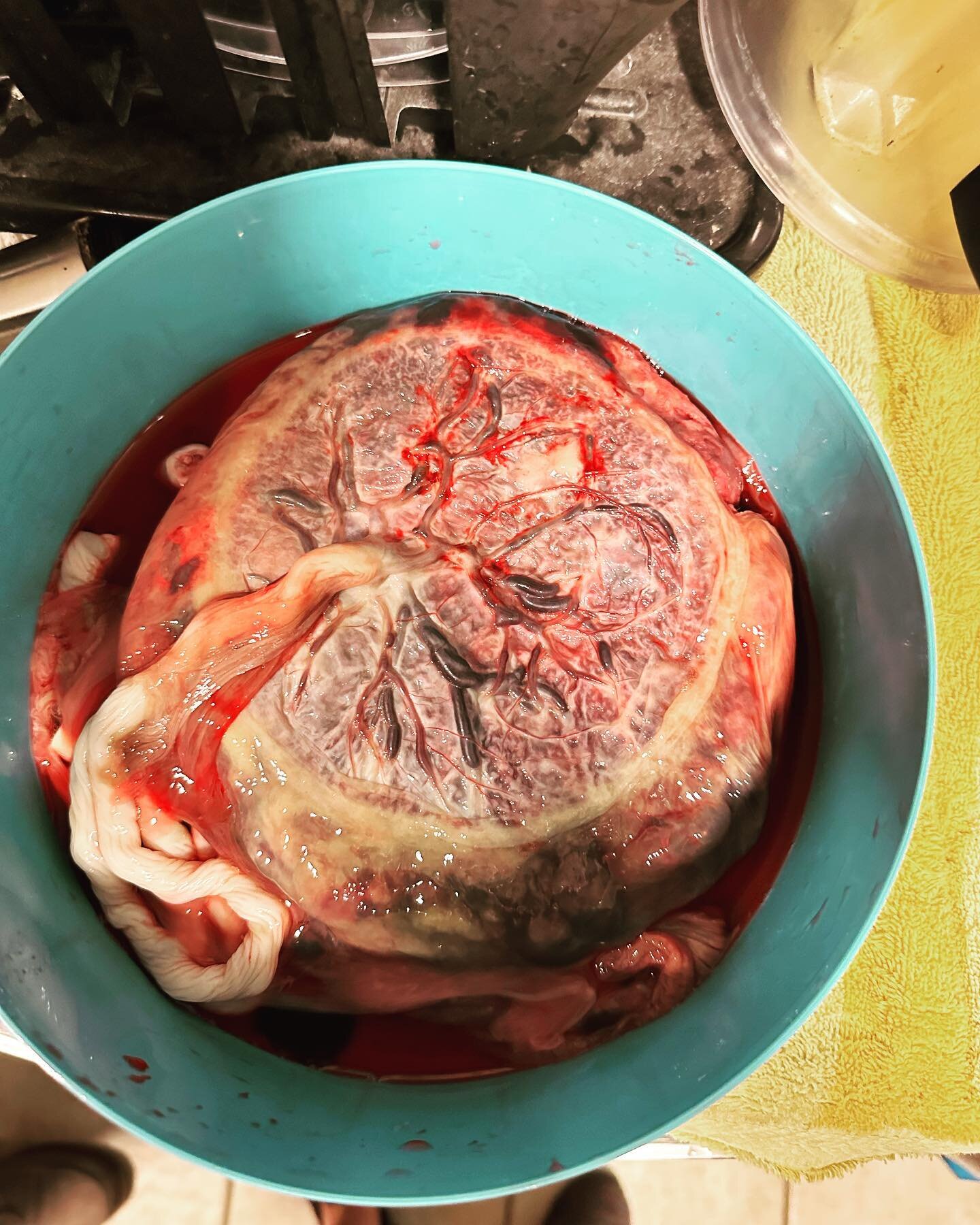 This was the most significant circumvallate placenta I have ever seen.  The mother is a very healthy eater and had no other issues. As is consistent with this anomaly, she presented with first and second trimester bleeding and baby was born early.  T