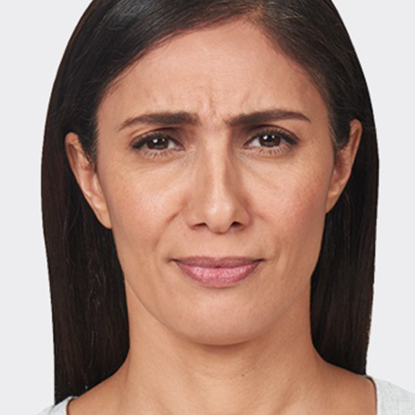 Frown Lines