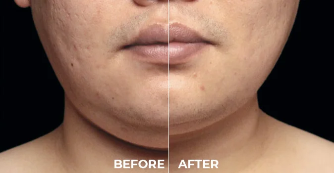 CoolSculpting Before and After on neck area.