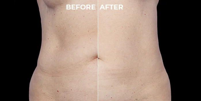 CoolSculpting Before and After on the Abdomen Area