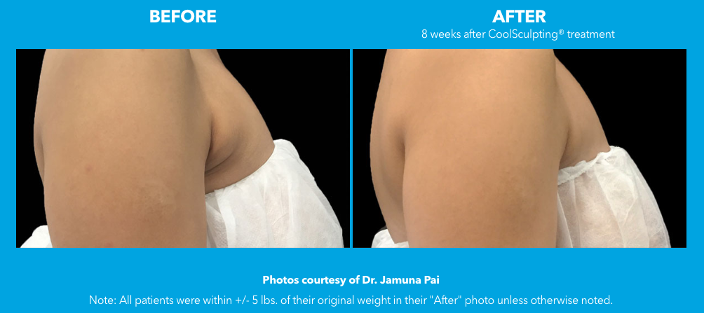 coolsculpting before and after