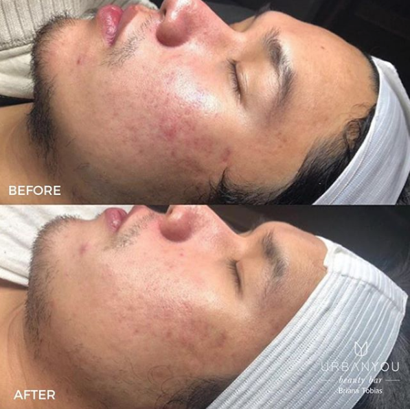 This before (top) and after (bottom) photo is 5 weeks apart from each other. These are real results for Urban You customers. Medical Aesthetician: Briana Tobias.