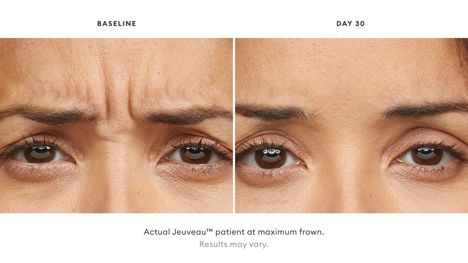 jeuveau patient before and after