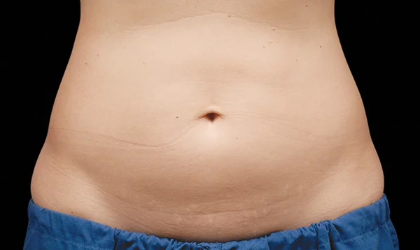 f-05-abdomen-before.jpg