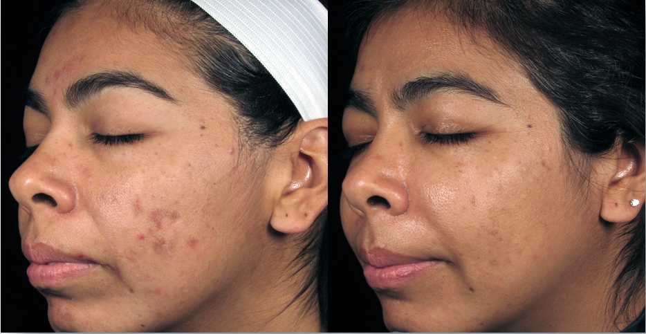  Treatment of Post-Inflammatory Hyperpigmentation – 5 Dermalinfusion Treatments – Once Every Two Weeks with Skin Brightening Pro-Infusion Serum with Lumixyl + Twice Daily Use Lumixyl Brightening Cream*    [courtesy Ashish Bhatia, M.D., Naperville, IL
