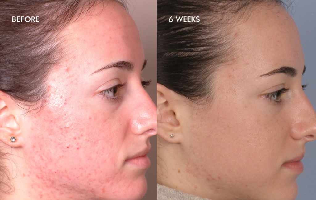  Treatment of Inflammatory Acne – 4 Dermalinfusion Treatments – Once Every Two Weeks with Pore Clarifying Pro-Infusion Serum*    