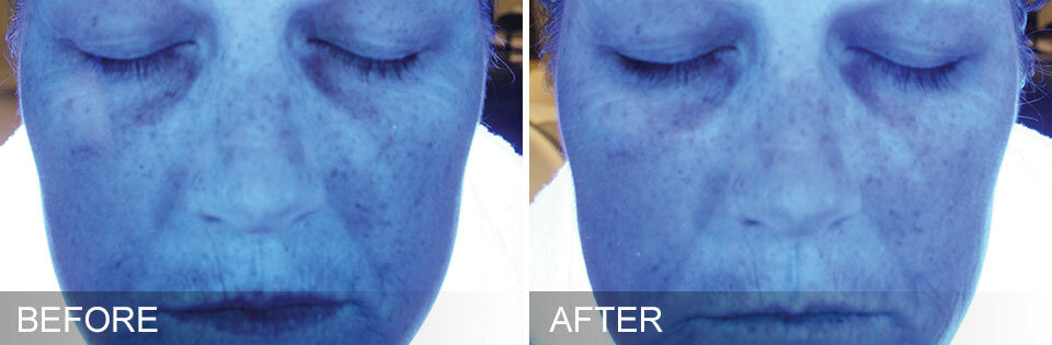 Hydrafacial for Dehydrated Skin