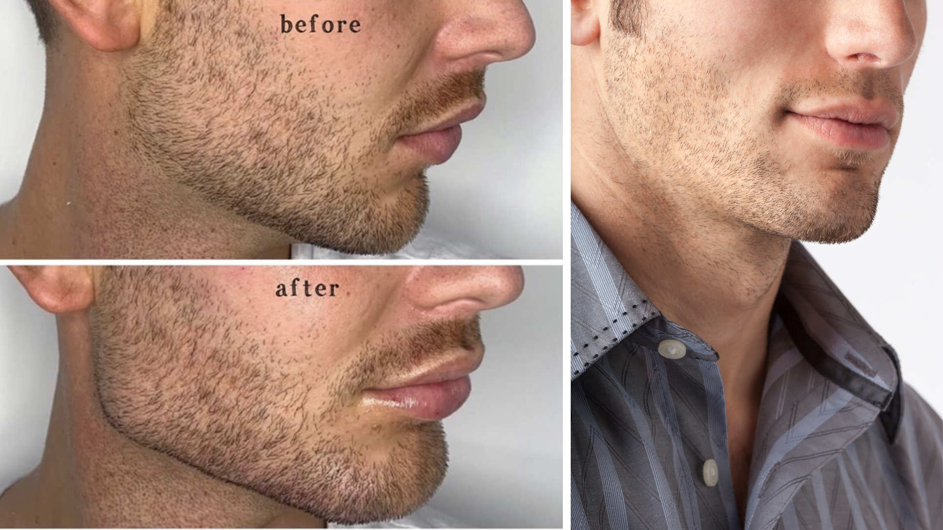 How to Get a Better Jawline - Procedures for a Chiseled Jaw