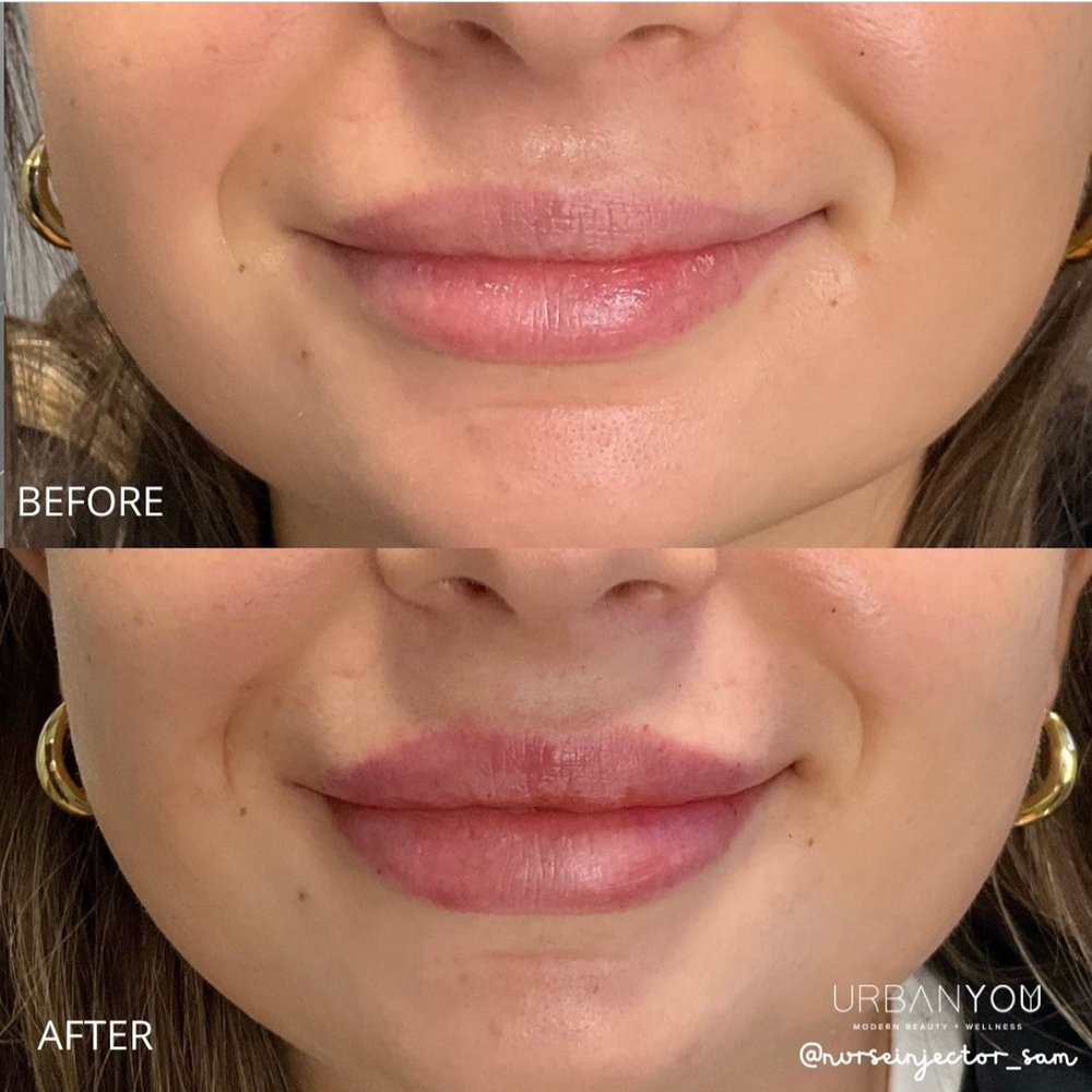 Pearlique Lips before and after photos