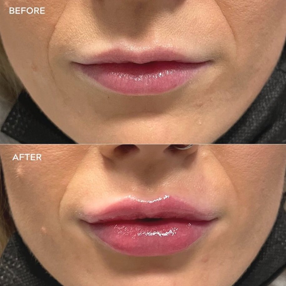 Pearlique lips before and after photos 