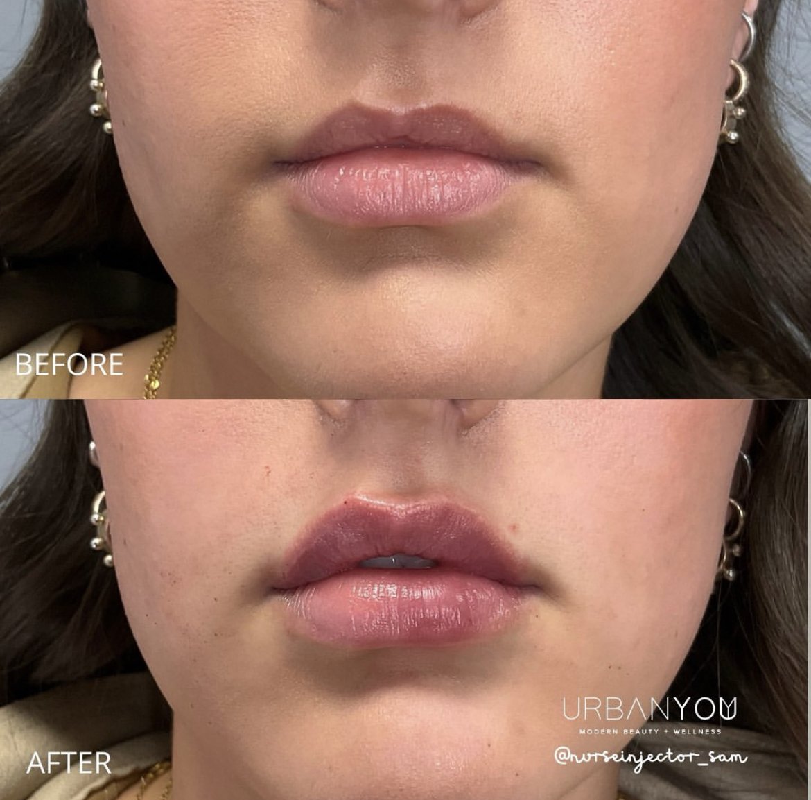 Lip Flip Before and After Photo