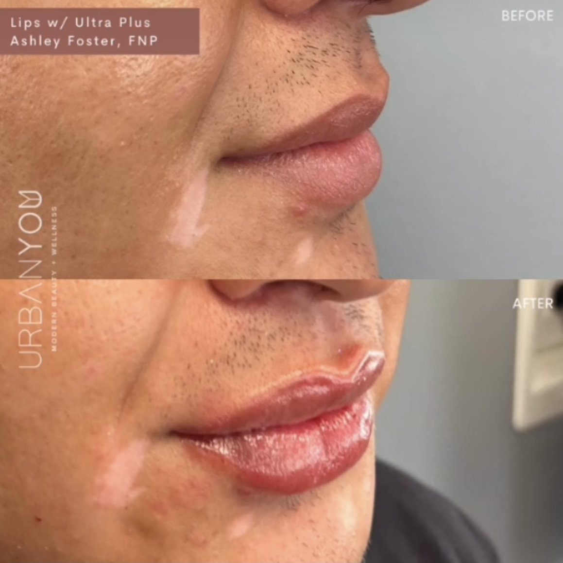 Lip filler before and after Instagram, The Urban You Medical Spa in Grand Rapids