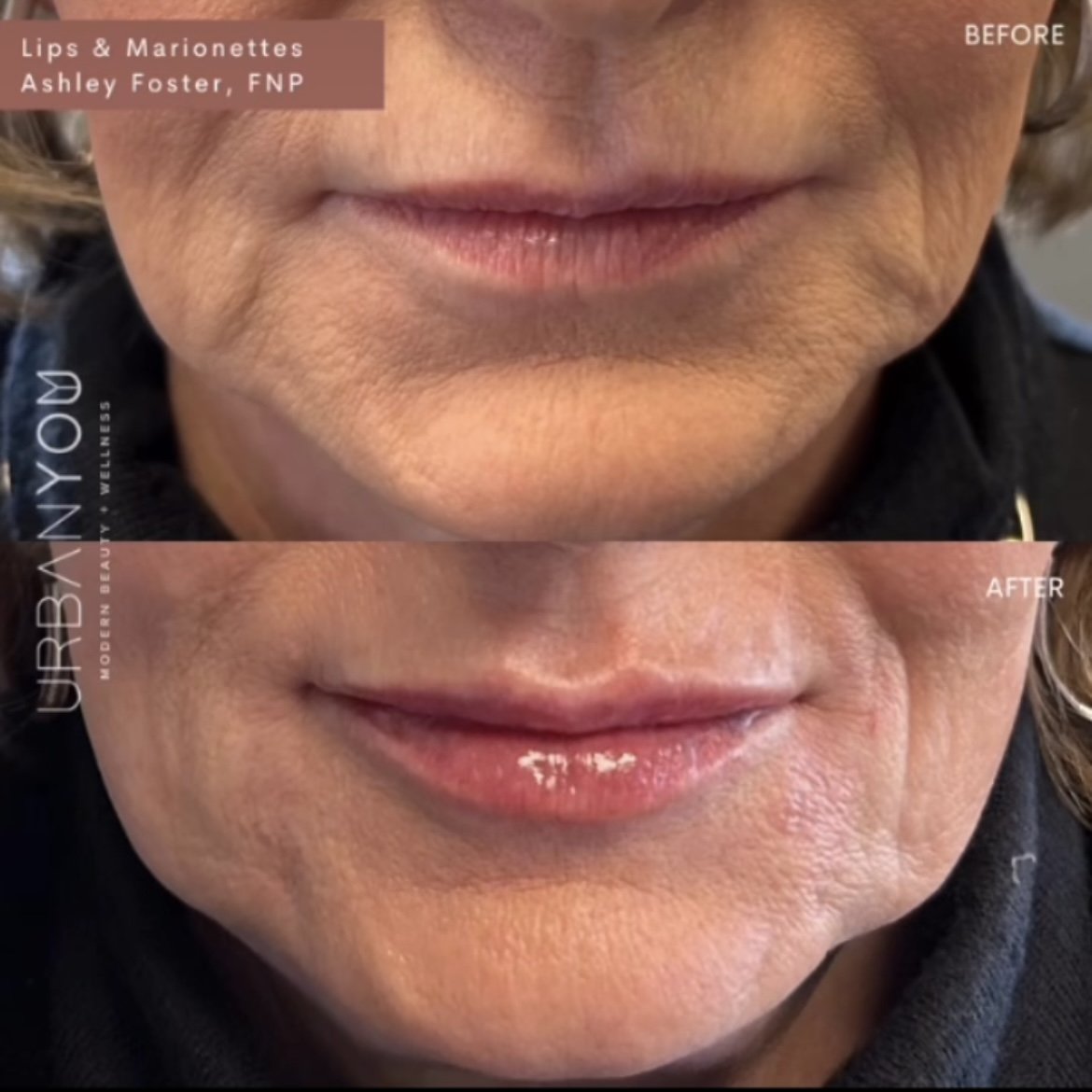 Lip filler before and after Instagram, The Urban You Medical Spa in Grand Rapids