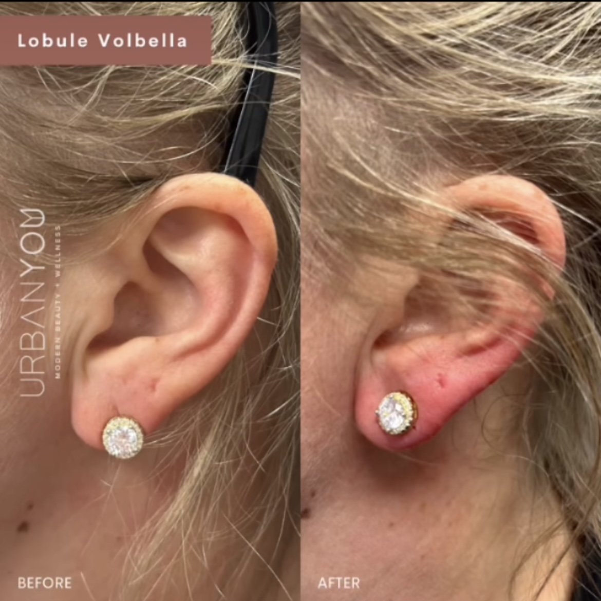 Earlobe filler with Vobella before and after Instagram, The Urban You Medical Spa in Grand Rapids