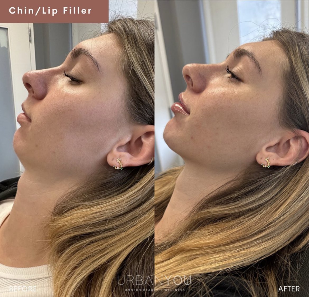 Lip and chin filler before and after Instagram, The Urban You Medical Spa in Grand Rapids