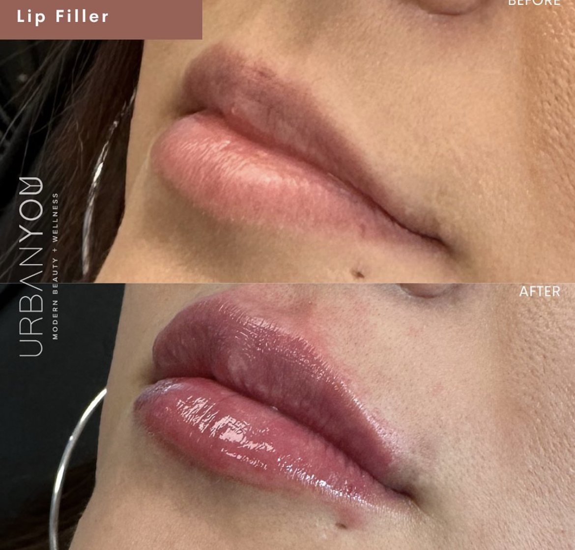 Lip filler before and after Instagram, The Urban You Medical Spa in Grand Rapids