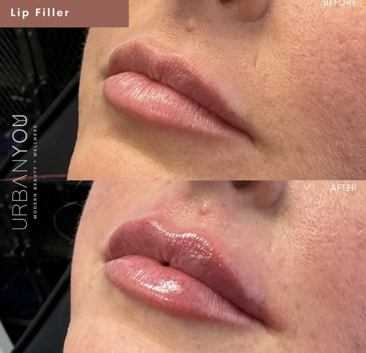 Lip filler before and after Instagram, The Urban You Medical Spa in Grand Rapids