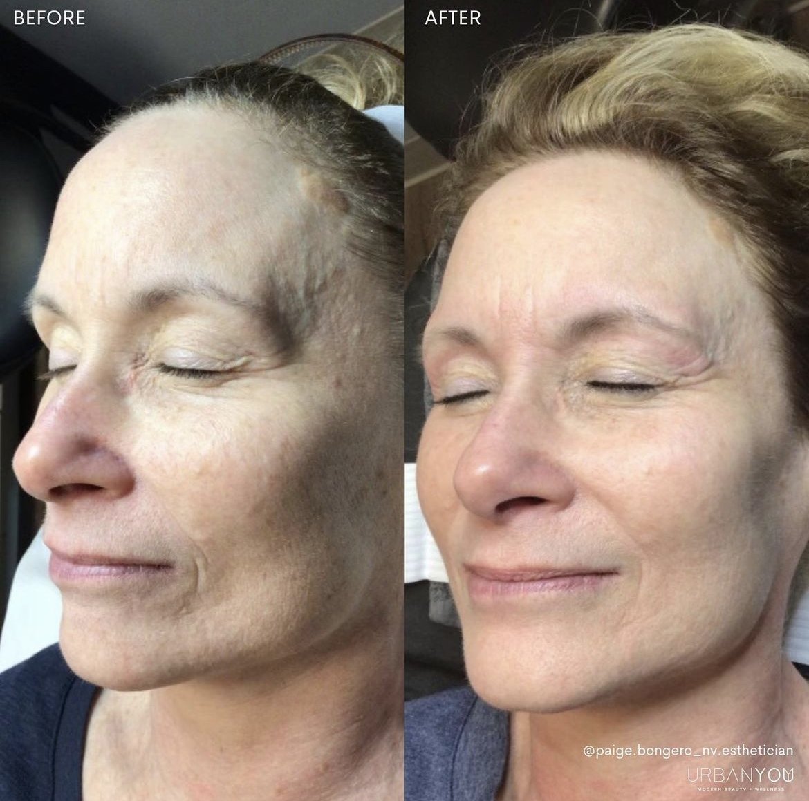Moxi laser treatment before and after Instagram, The Urban You Medical Spa in Northville, Michigan