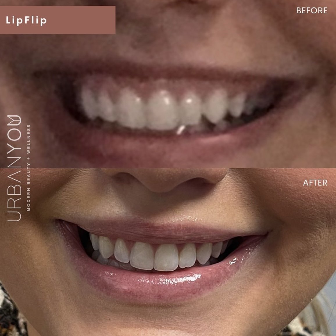 Kristina Gould Lip Flip before and after, The Urban You Medical Spa in Grand Rapids Instagram (Copy)