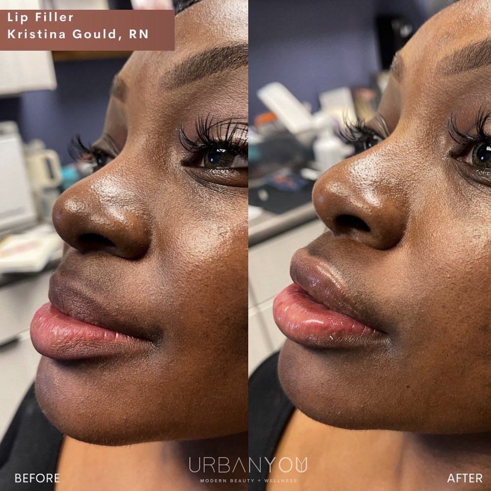 Kristina Gould Lip Flip before and after, The Urban You Medical Spa in Grand Rapids Instagram (Copy)