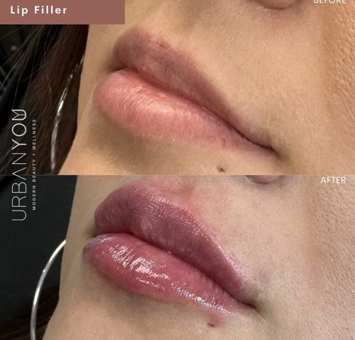 Filler Before &amp; After Photos: Lips, Cheeks, Mouth Lines