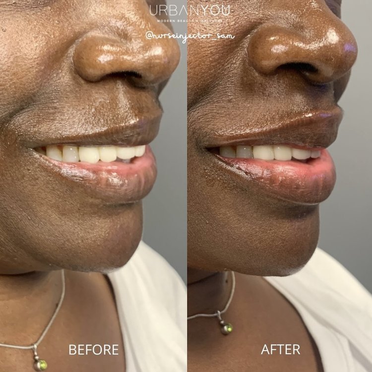 Filler Before &amp; After Photos: Lips, Cheeks, Mouth Lines