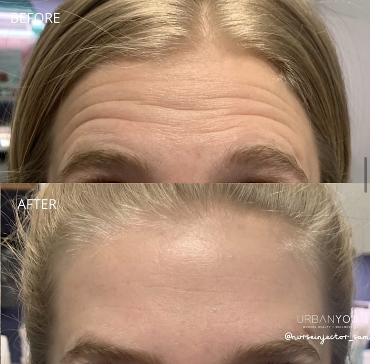 Botox for forehead wrinkles before and after photo