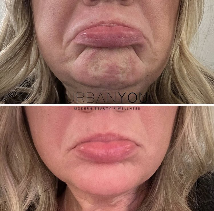 Botox for Chin before and after photo