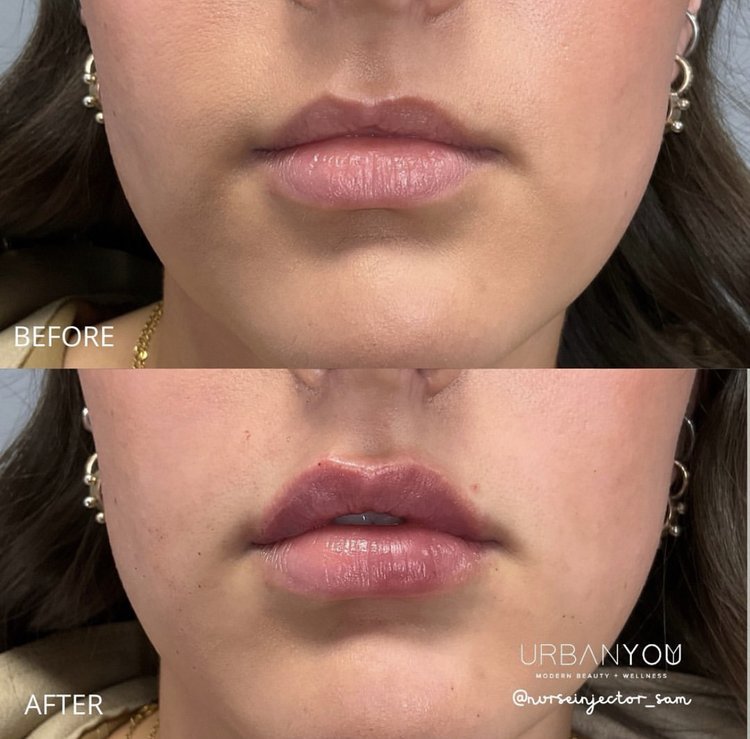 Lip flip and russian lips with Botox before and after photo