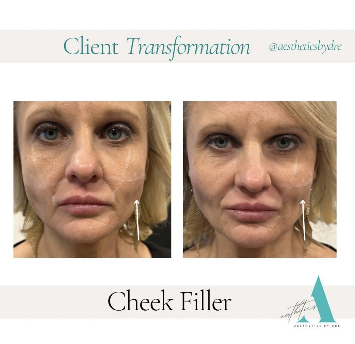 Andrea VanBeek Cheek Filler Before and After Photo