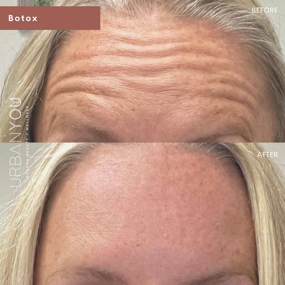 Botox Before &amp; After in Forehead