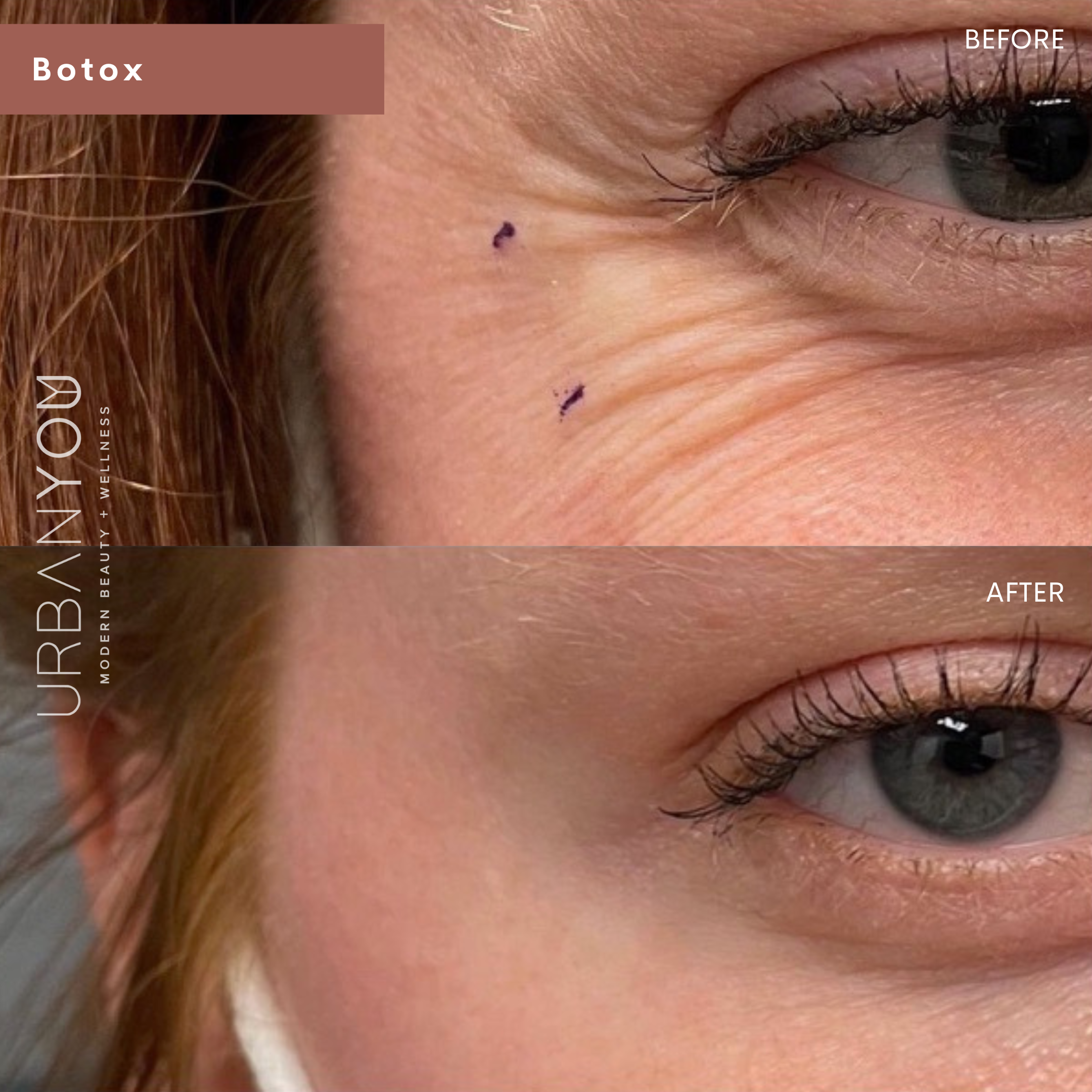 Botox Crow's Feet Before &amp; After
