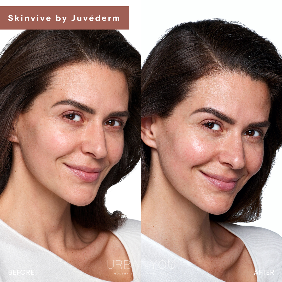 SkinVive by Juvéderm Before and After Photo Urban You