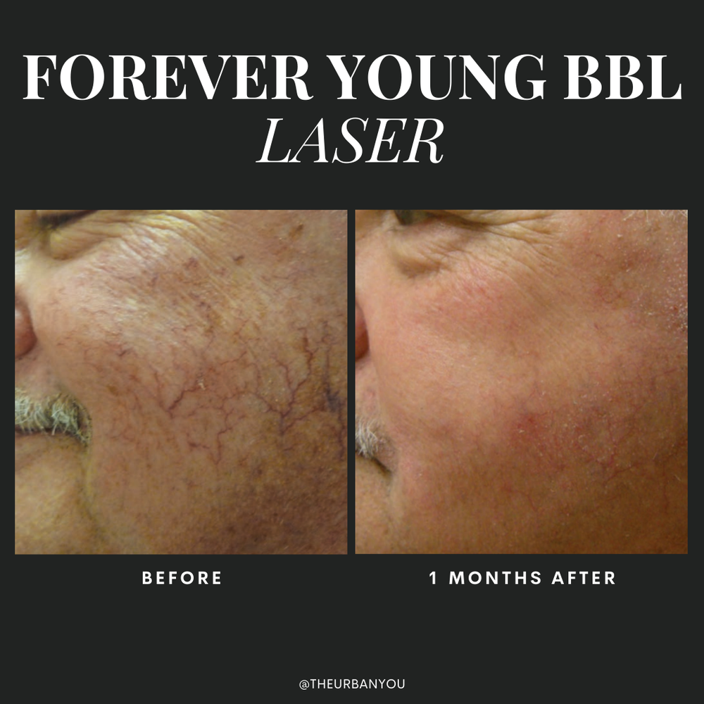 Men's laser treatment before and after Urban You medical spa in Grand Rapids and Northville, Michigan