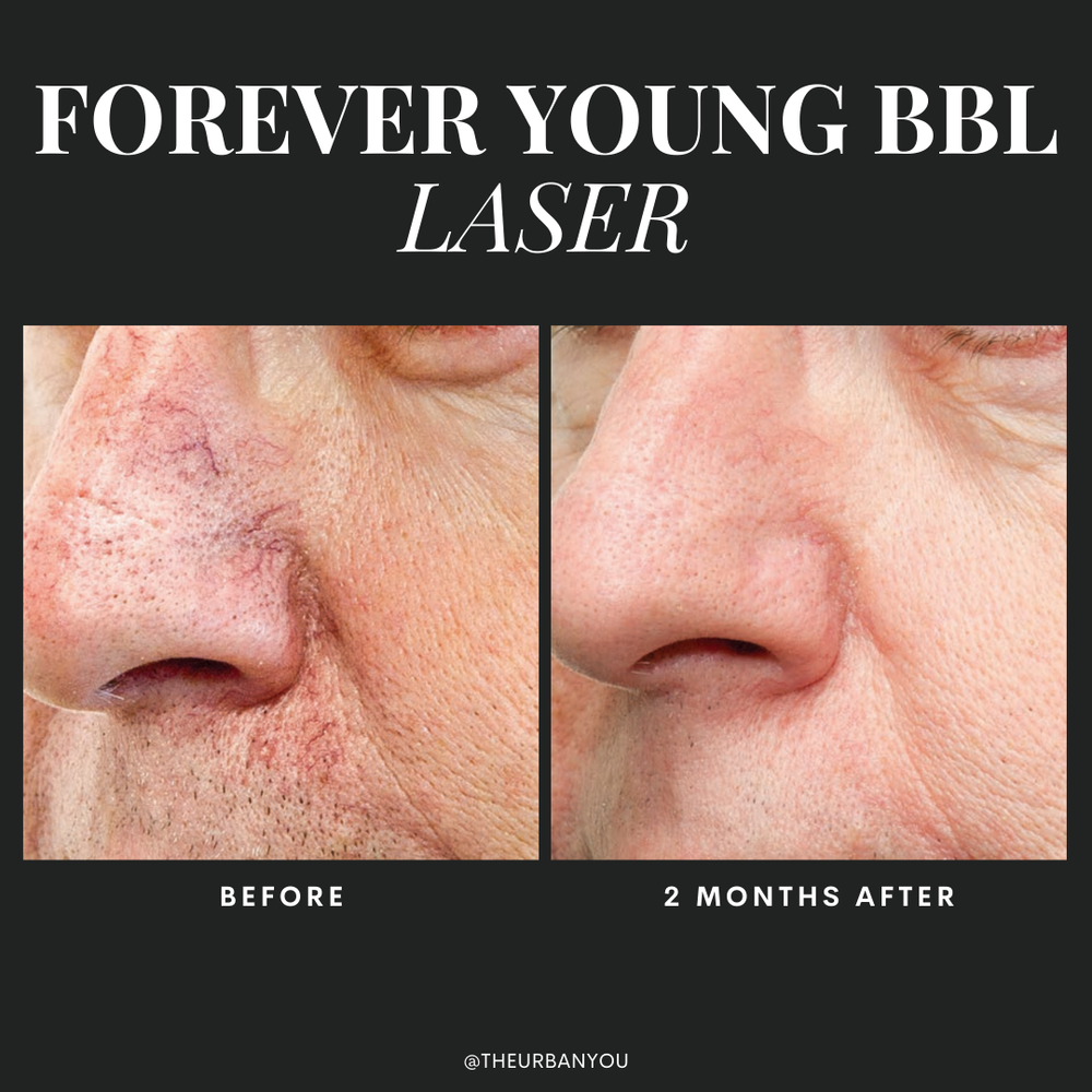 Men's laser treatment before and after photo Urban You medical spa