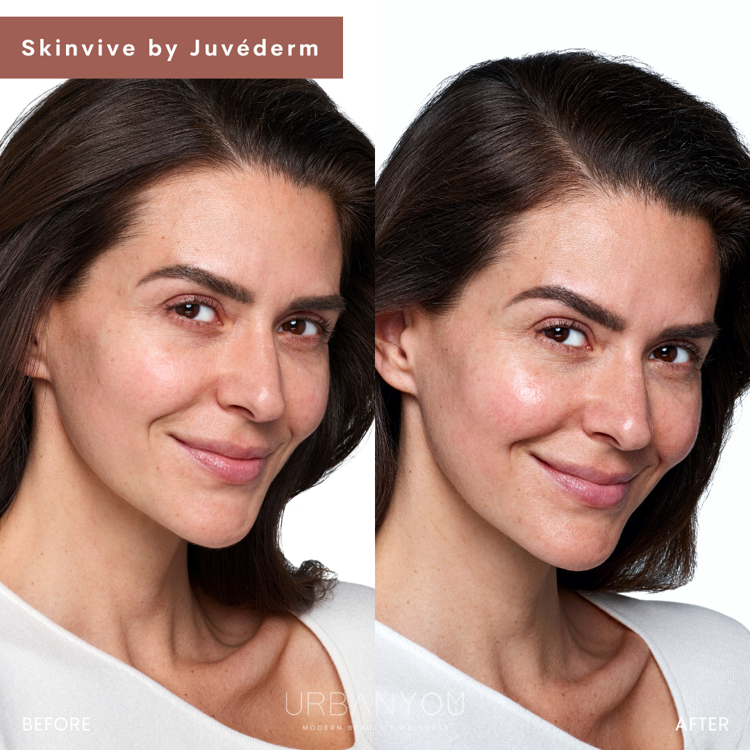 SkinVive by Juvéderm for men before and after photos, Urban You medical spa in Grand Rapids and Northville, Michigan 