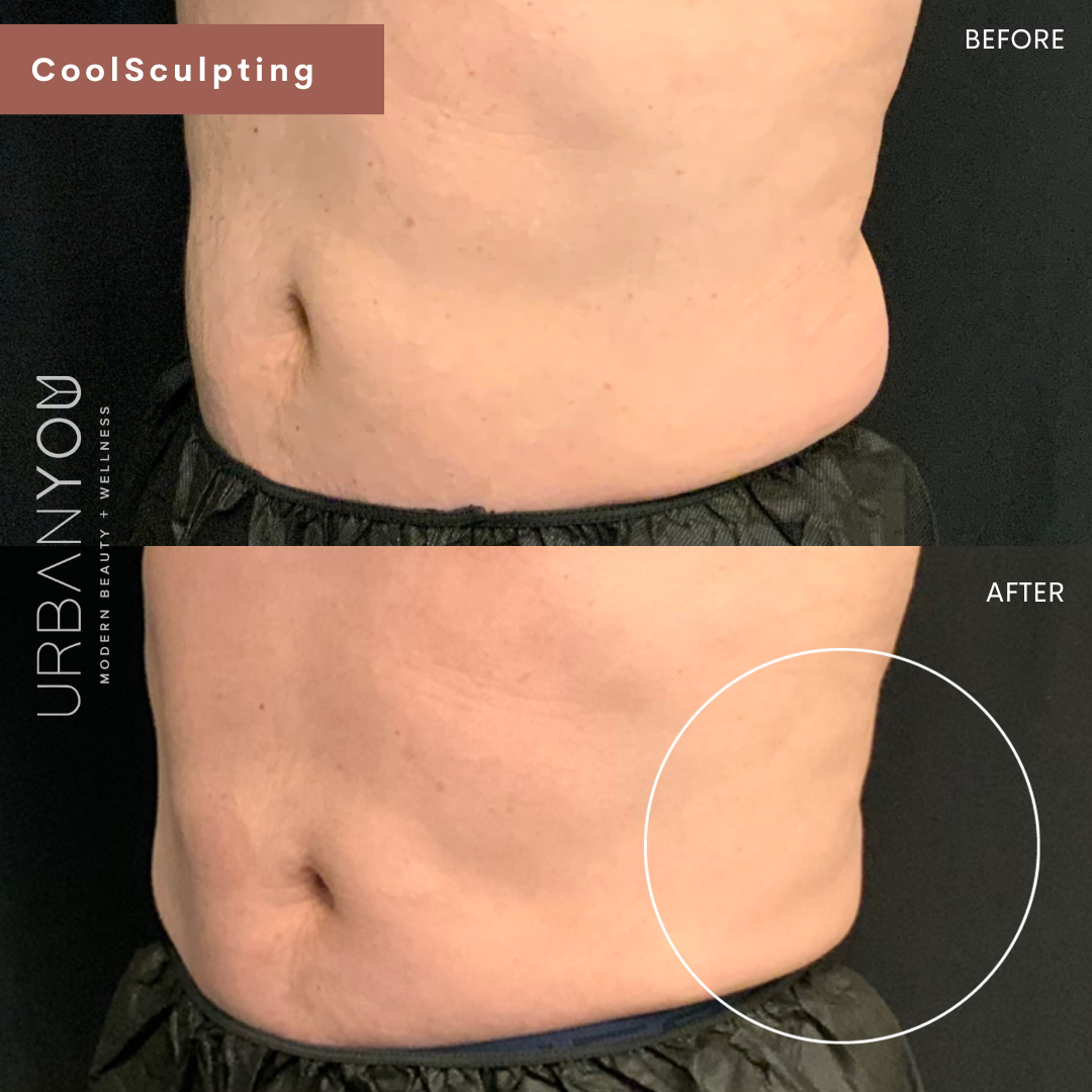 men's coolsculpting elite before &amp; after photo at Urban You medical spa in Grand Rapids, Northville, and Rockford, MI